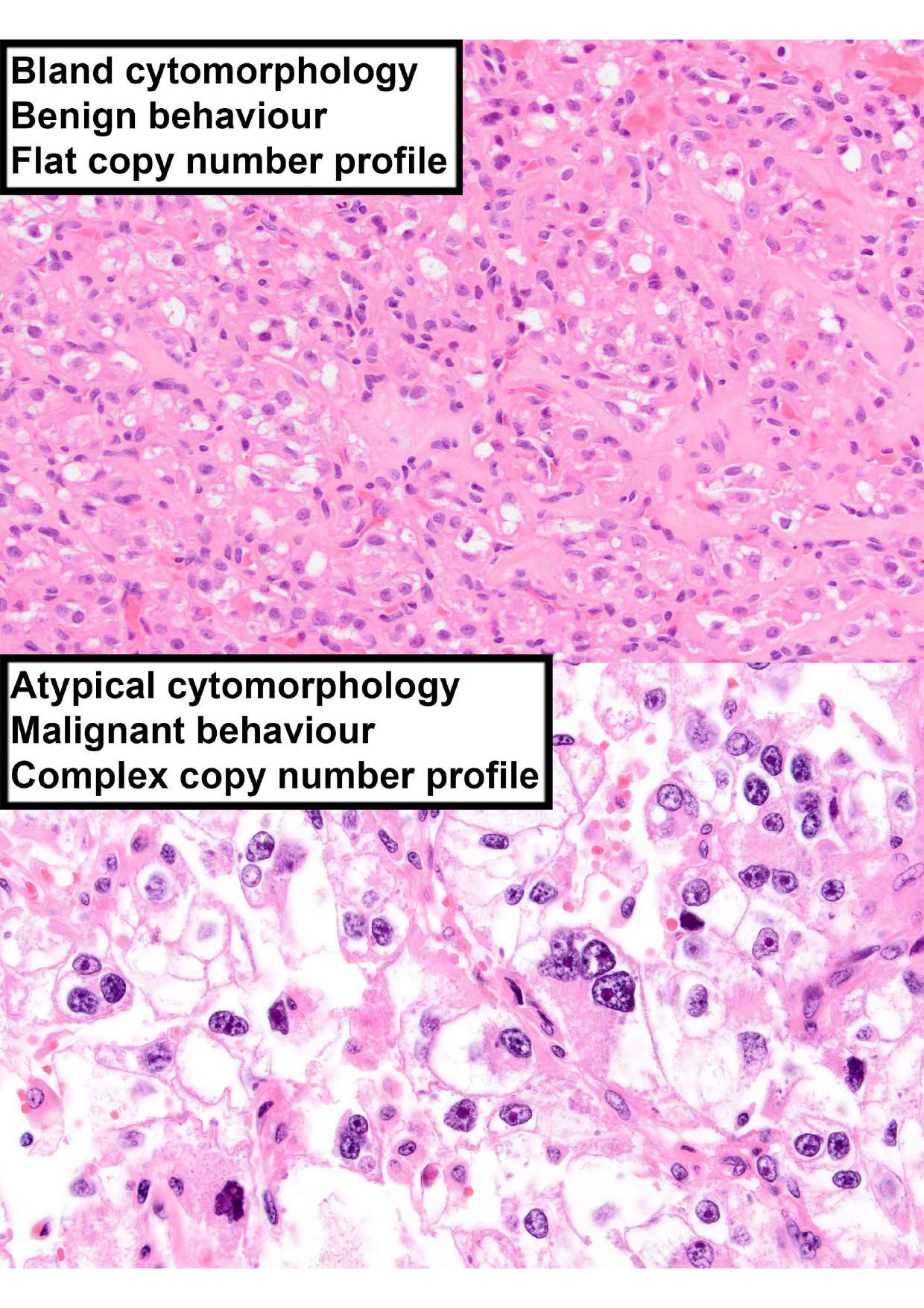 Genetic correlates of malignancy in TFE3-rearranged PEComa: a series of 14 cases